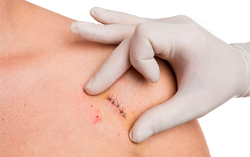 Enfermeiro agora pode realizar de sutura simples