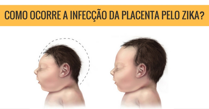 Estudo aponta como ocorre a infecção da placenta pelo zika